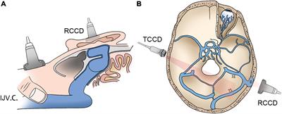 Retroauricular/Transcranial Color-Coded Doppler Ultrasound Approach in Junction With Ipsilateral Neck Compression on Real-Time Hydroacoustic Variation of Venous Pulsatile Tinnitus